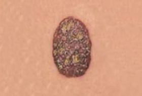 B&eacute;nin 11b