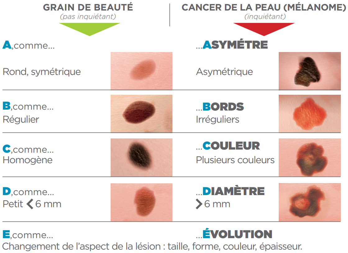 Prévention cancer de la peau : Règle ABCDE